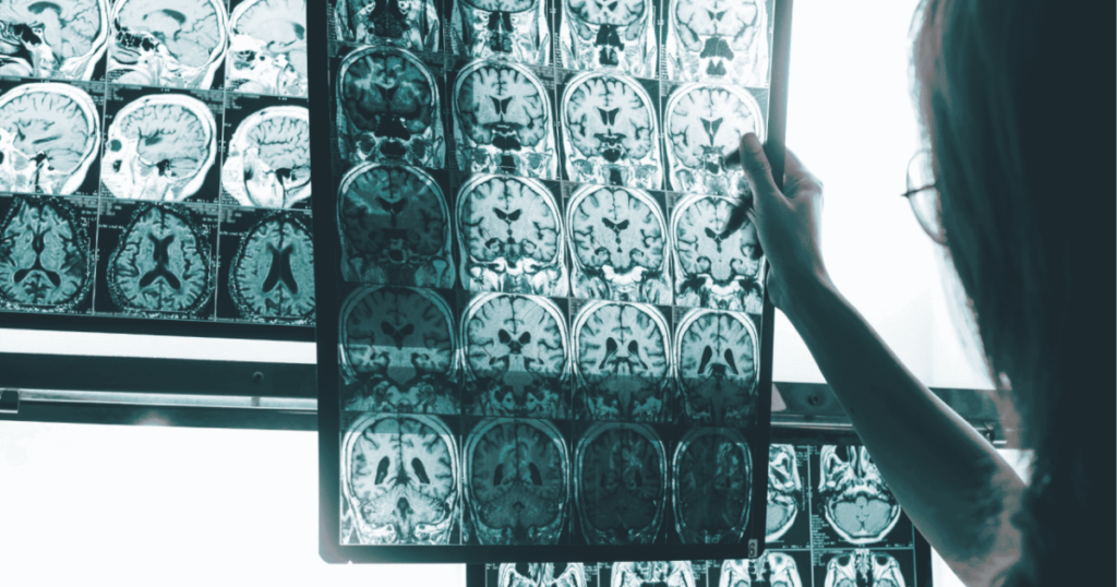 Un índice nuevo ayuda a medir el Alzheimer y vuelve a evidenciar que la enfermedad actúa años antes de los síntomas