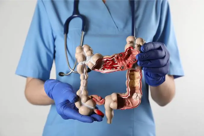 Denuncian 109 cupos pendientes en Alto Costo para pacientes con Crohn