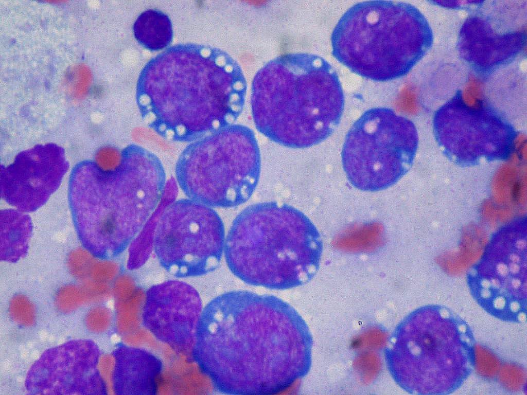 Especialistas descartan las promesas de curas dietéticas contra el cáncer y subrayan el papel de la obesidad